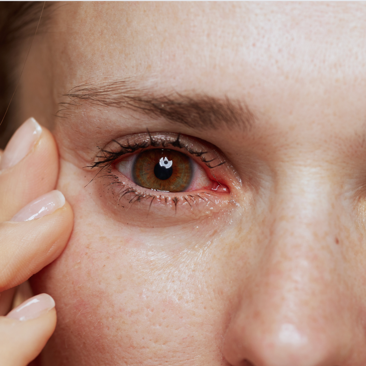 How to Get Rid of Red Eyes CHome Remedies & Tips for Prevention Adasat